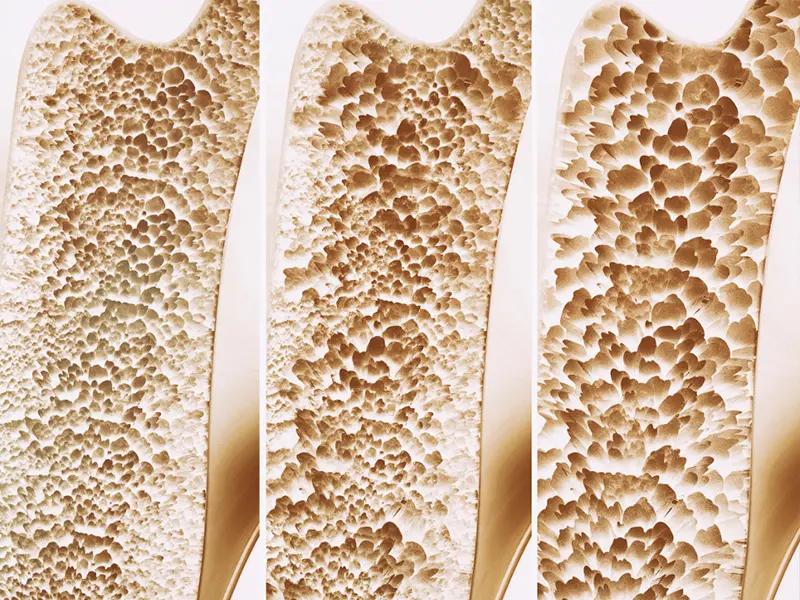 osteoparoz